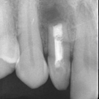 歯根端切除術 術後4ヶ月